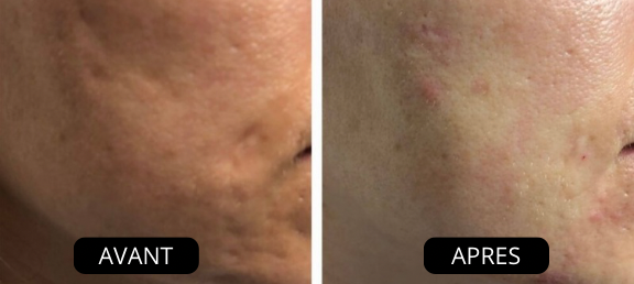 NüVia™ pommeau de douche haute pression